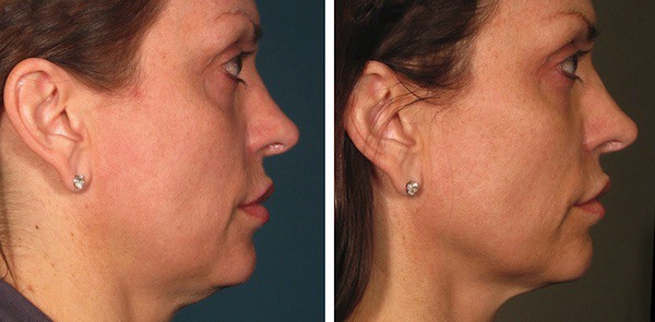 ultherapy