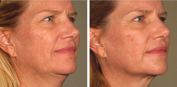 ultherapy